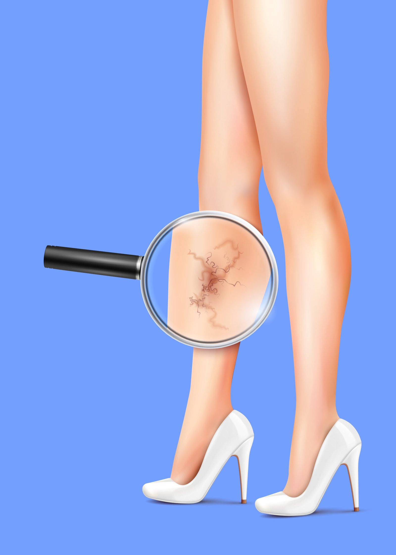 Treatments Varicose Veins