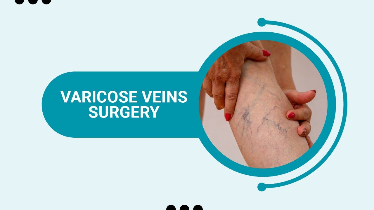 Varicose Veins