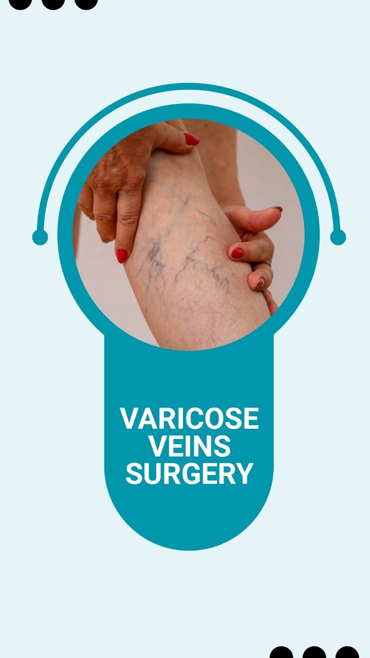 Varicose Veins