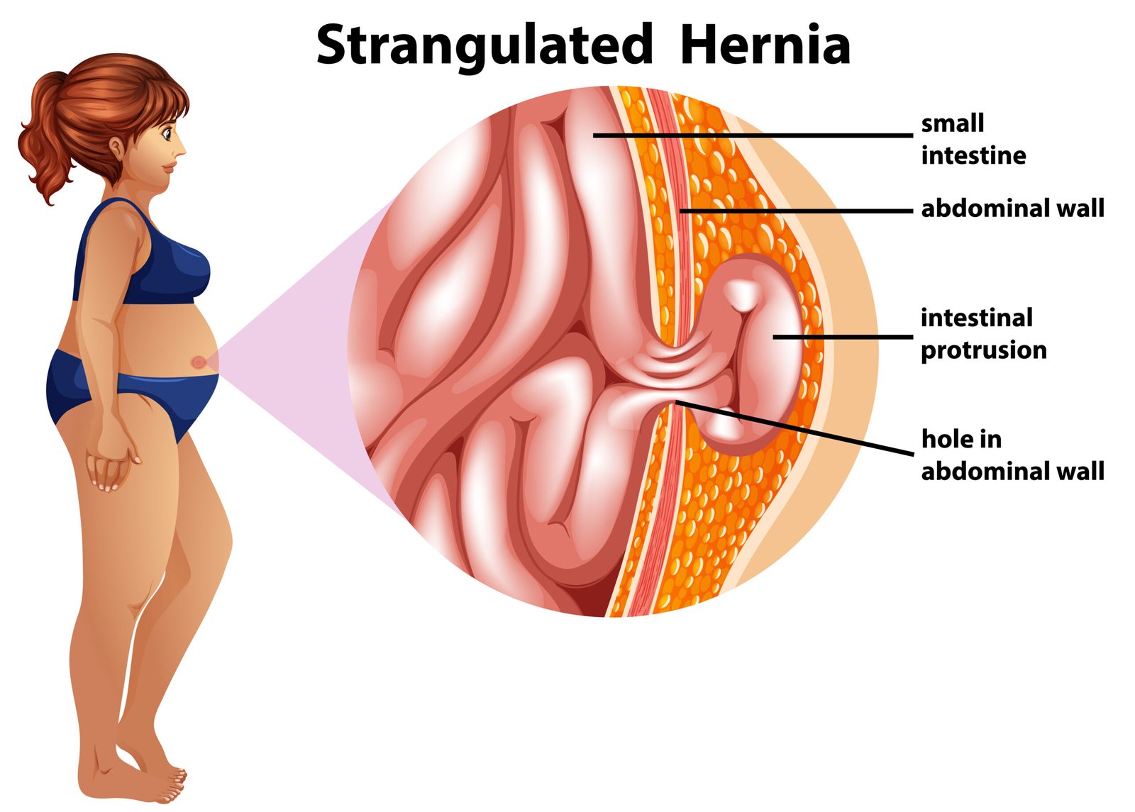 symptoms of Hernia